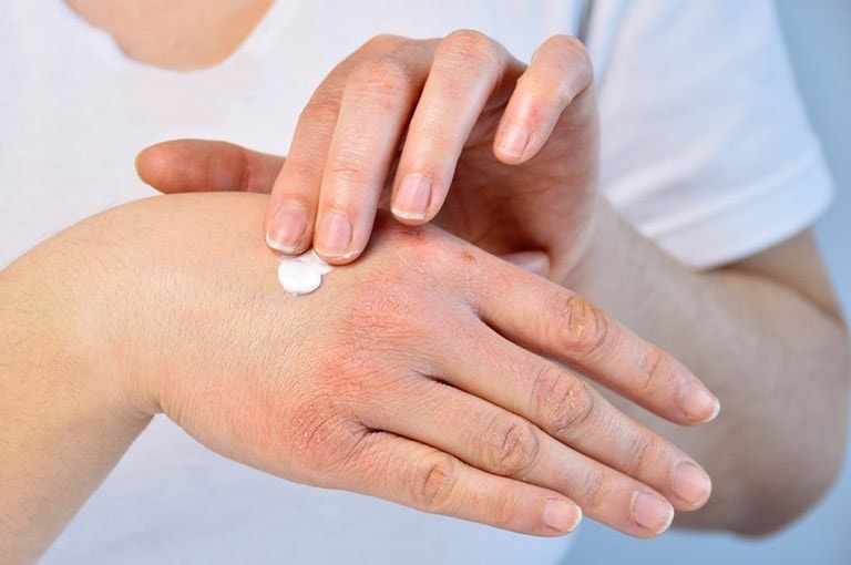 Dưỡng ẩm cho da đều đặn có thể giảm nhanh tình trạng ngứa, khô ráp và bong tróc