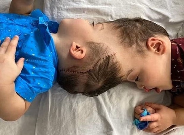 Bernardo và Arthur Lima (gần 4 tuổi) dính liền với nhau ở đầu, bao gồm một phần não, kể từ khi sinh ra.(Nguồn: PA)