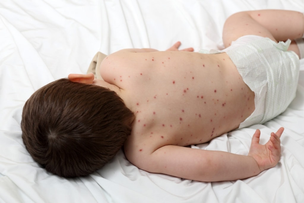 (Tổng hợp) Những điều cần biết về bệnh thủy đậu 1