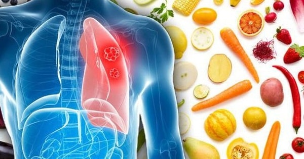 (Tổng hợp) Những điều người bị bệnh viêm phổi cần lưu ý
