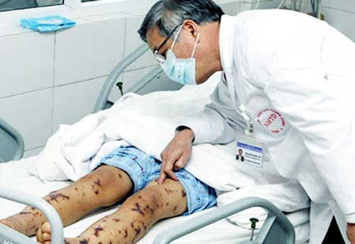 (Tổng hợp) Những điều cần lưu ý về bệnh viêm màng não do liên cầu lợn 1