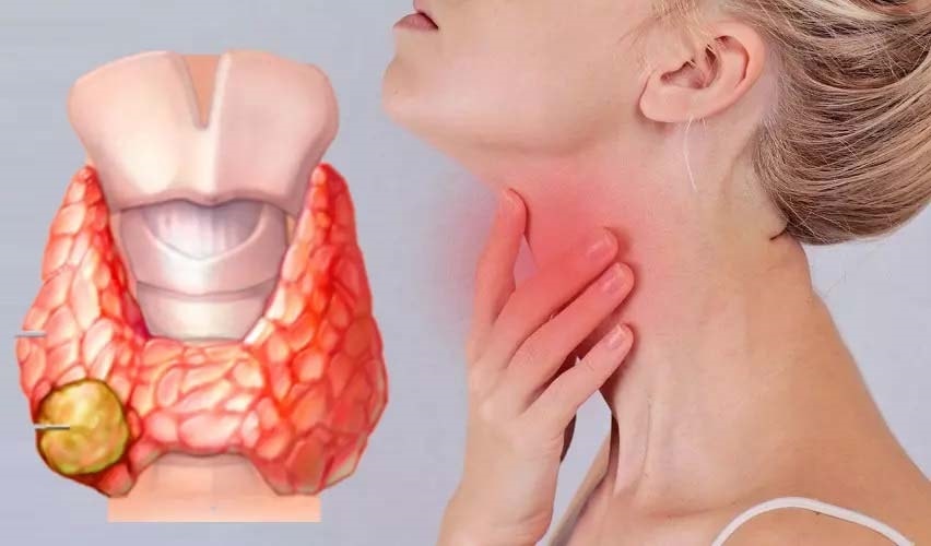 (Tổng hợp) Các yếu tố nguy cơ gây ung thư tuyến giáp cần lưu ý
