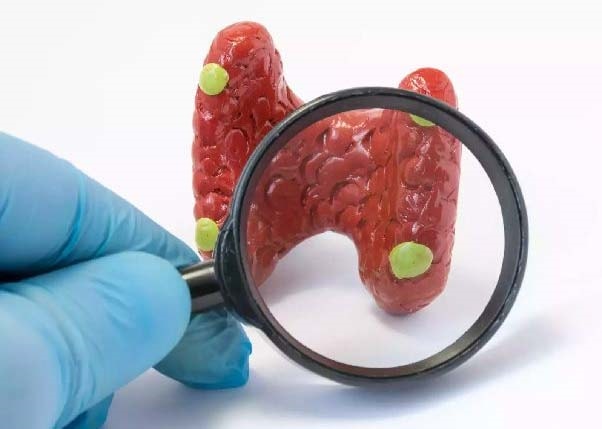 (Tổng hợp) Các yếu tố nguy cơ gây ung thư tuyến giáp cần lưu ý 1