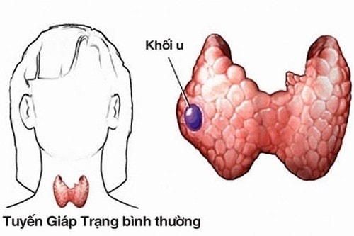 (Tổng hợp) Các yếu tố nguy cơ gây ung thư tuyến giáp cần lưu ý 2