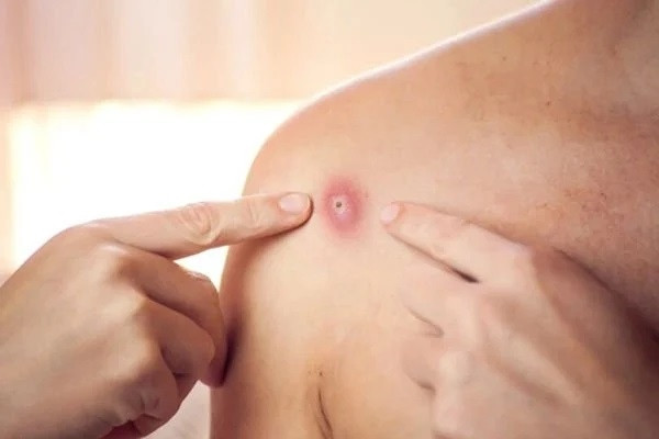 Cà Mau ghi nhận trường hợp mắc bệnh đậu mùa khỉ đầu tiên. Ảnh minh họa