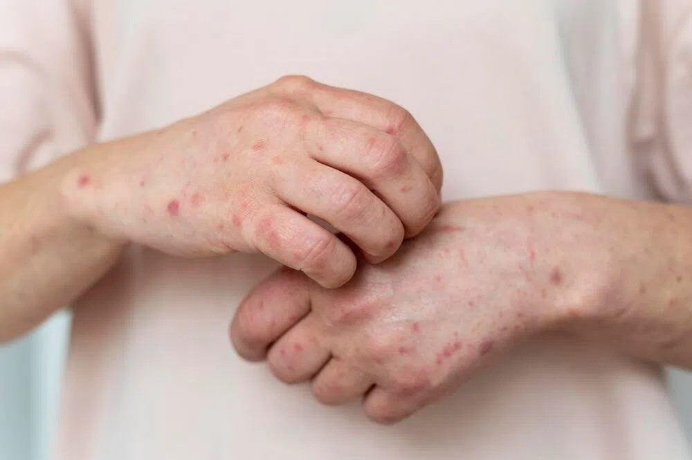 Cần chủ động giám sát, phát hiện sớm trường hợp mắc bệnh, kiểm soát dịch kịp thời, không để bùng phát dịch bệnh đậu mùa khỉ. Ảnh minh họa