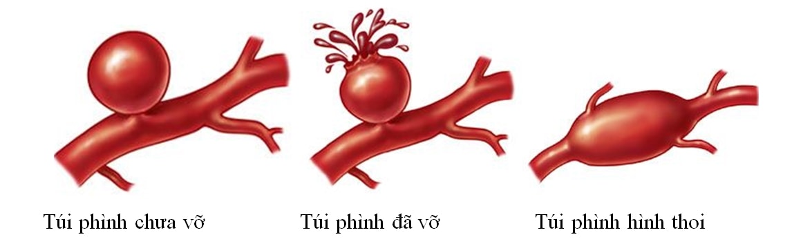 (Tổng hợp) Bệnh phình mạch máu não-Những dấu hiệu bạn cần lưu ý 2