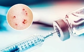 (Tổng hợp) Hướng dẫn xử lý vết thương khi bị chó, mèo cắn để tránh bệnh dại 2