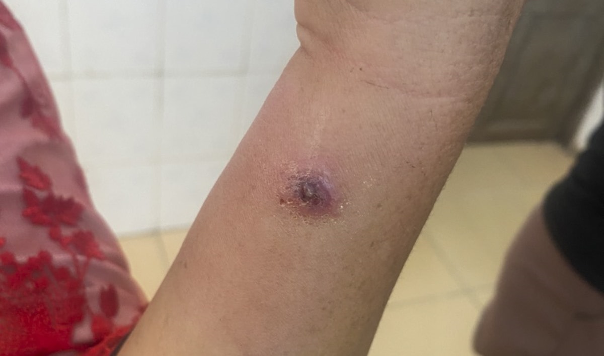 (Tổng hợp) Những điều bạn chưa biết về bệnh than 1