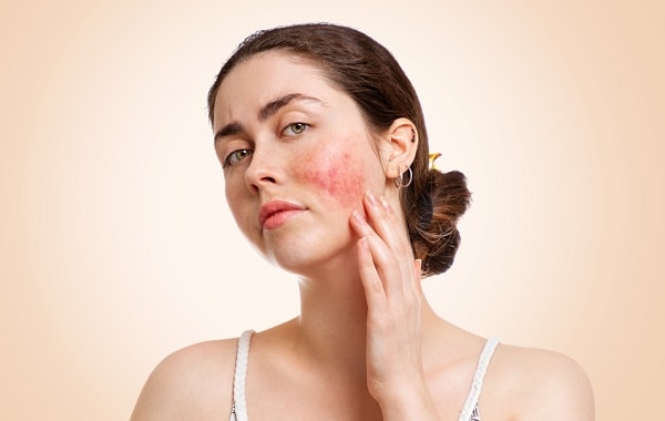 (Tổng hợp) Những điều bạn chưa biết về bệnh Lupus ban đỏ hệ thống 1