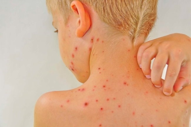 (Tổng hợp) Những điều bạn chưa biết về bệnh Lupus ban đỏ hệ thống 3