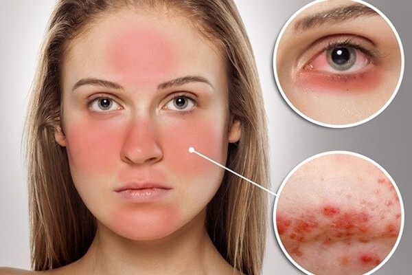 (Tổng hợp) Những điều bạn chưa biết về bệnh Lupus ban đỏ hệ thống 2