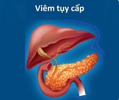 (Tổng hơp) Những điều cần biết về bệnh viêm tụy cấp 1