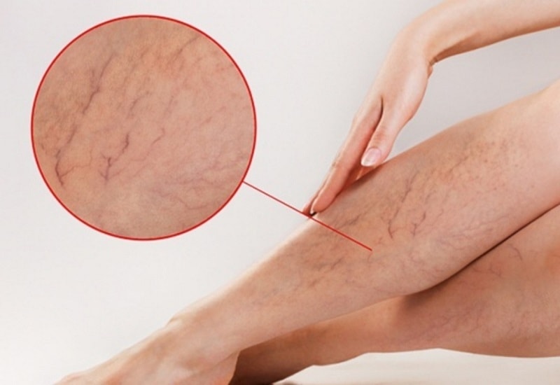 (Tổng hợp) Hướng dẫn cách phòng, tránh giãn mao mạch