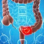 Nguyên nhân hàng đầu dẫn đến bệnh ung thư phổ biến thứ 3 ở nữ giới 