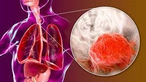 Barrett thực quản là một trong những nguyên nhân dẫn đến ung thư thực quản