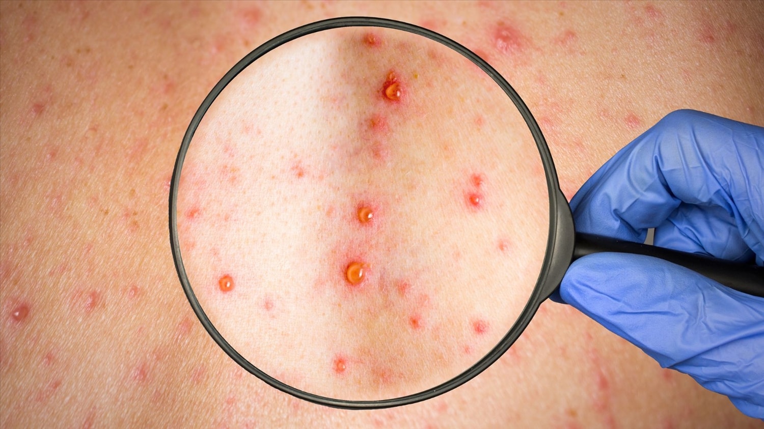 Nguyên nhân bệnh zona là do virus Varicella zoster