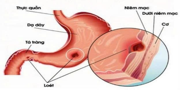 Rễ mùi tàu, cam thảo trị viêm dạ dày