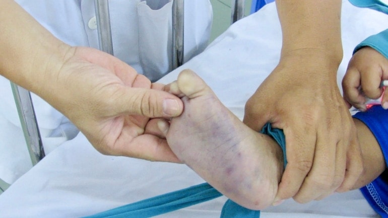 Những biểu hiện rõ của bệnh tay chân miệng ở trẻ em. Ảnh: ITN