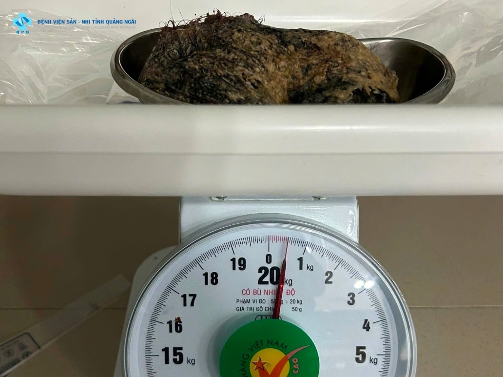 Sau khi phẫu thuật, búi tóc được lấy ra, cân nặng 0,5kg. (Ảnh: Bệnh viện Sản - Nhi  tỉnh Quảng Ngãi cung cấp)