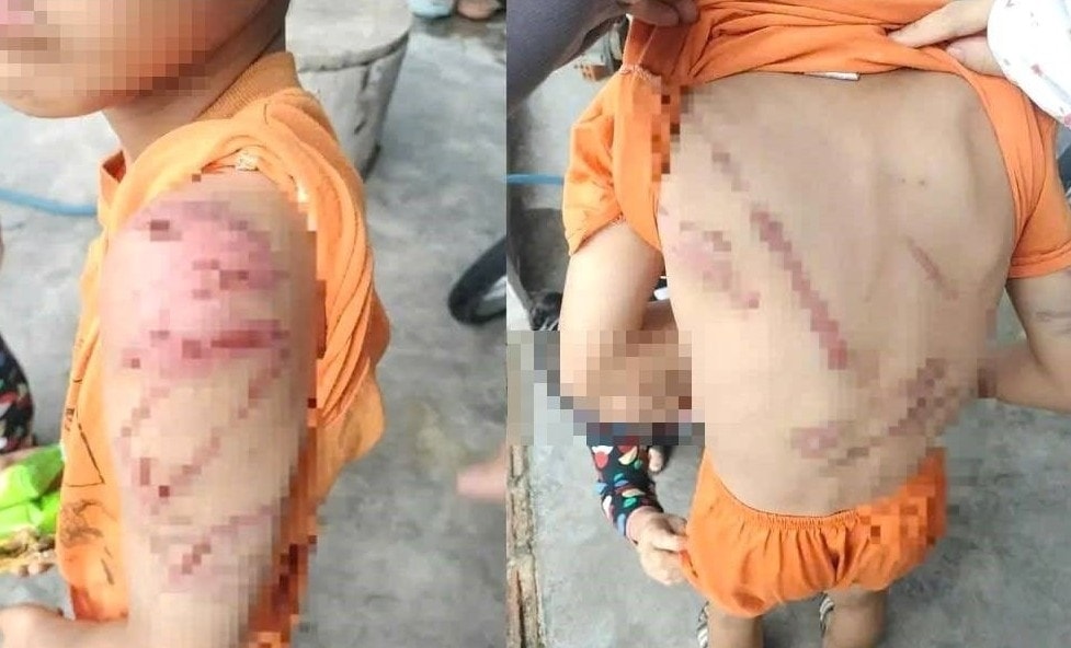 Những vết bầm tím trên người cháu D. (Ảnh: MXH)