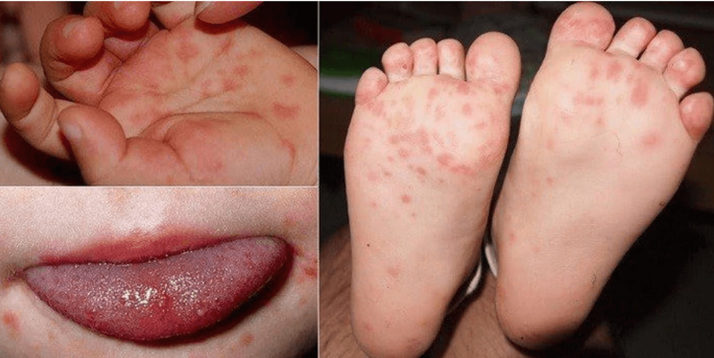 Những triệu chứng của bệnh tay chân miệng. Ảnh minh hoạ