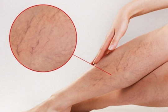 Hướng dẫn cách phòng, tránh giãn mao mạch