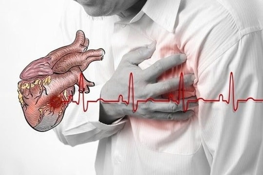 Nhận biết sớm những dấu hiệu cảnh báo - "Thời gian vàng" tránh nhồi máu cơ tim