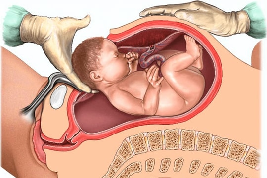 Mổ lấy thai chủ động: Cái giá của “ngày đẹp” có thể là sinh mạng