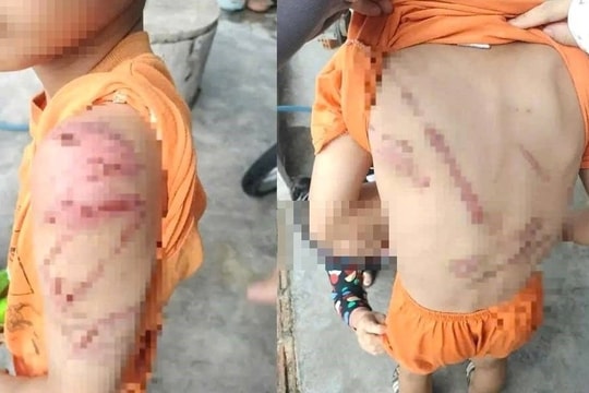 Công an thông tin việc bé trai bị bố đánh bầm tím chi chít