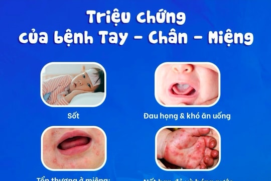 Khánh Hòa xuất hiện 21 ổ dịch tay chân miệng, tăng gấp 4 lần so với cùng kỳ