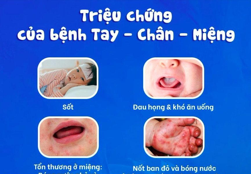 Khánh Hòa xuất hiện 21 ổ dịch tay chân miệng, tăng gấp 4 lần so với cùng kỳ