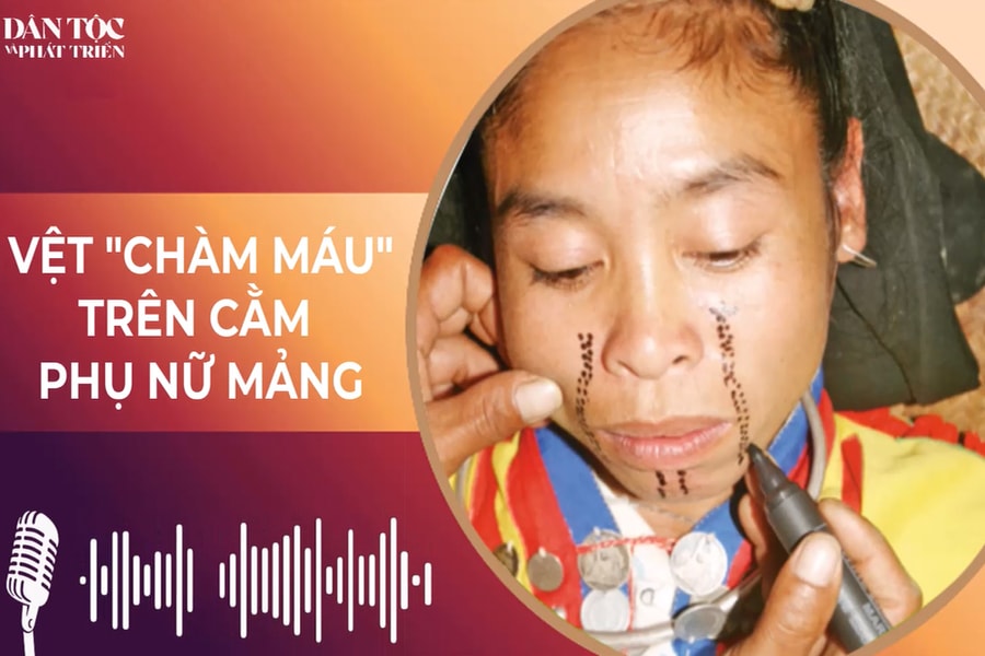 [Podcast] Vệt “chàm máu” trên cằm phụ nữ Mảng